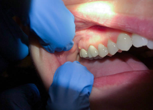 Best Emergency Dentist for Knocked-Out Tooth in White Marsh, MD